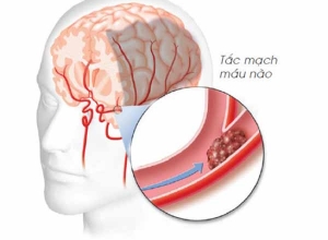 Đừng chủ quan nếu bạn chưa biết hậu quả của nhồi máu não đáng sợ như thế nào